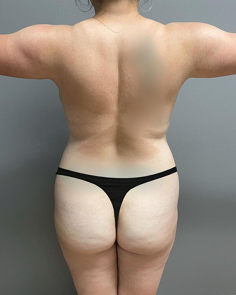 Brazilian Butt Lift Before & After