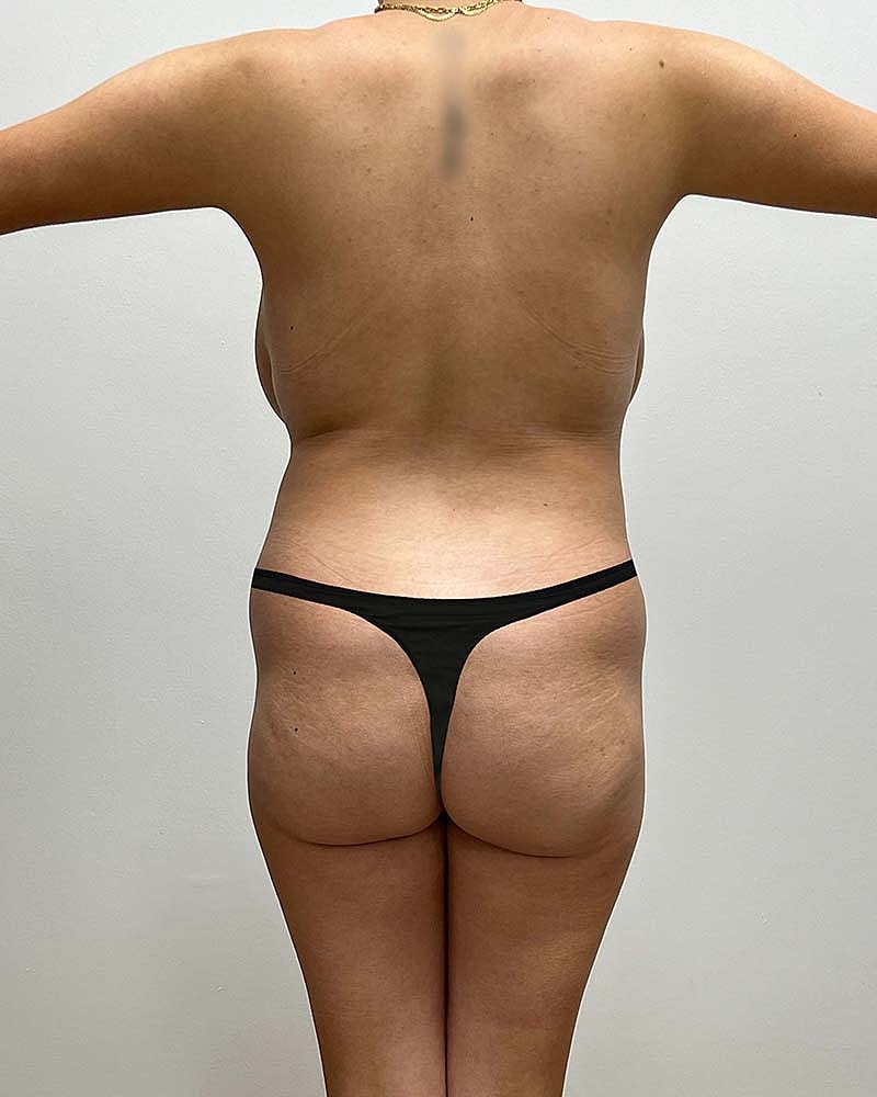 Brazilian Butt Lift Before & After