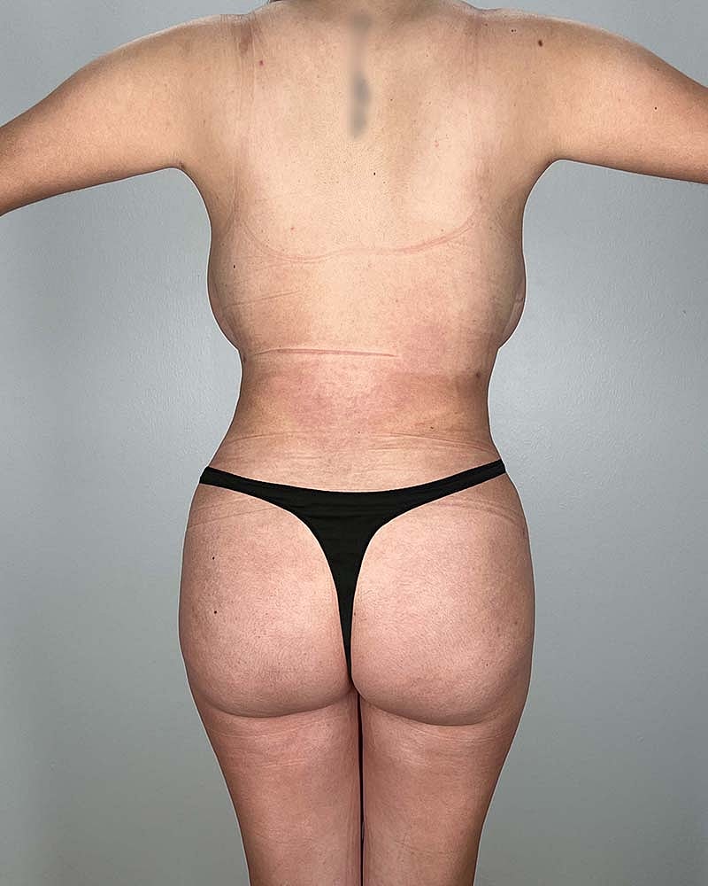 Brazilian Butt Lift Before & After