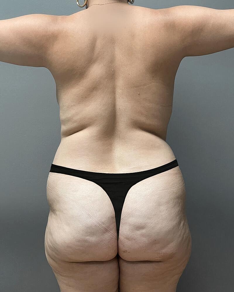 Brazilian Butt Lift Before & After