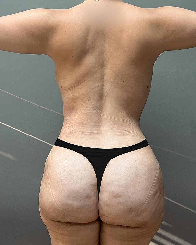 Brazilian Butt Lift Before & After