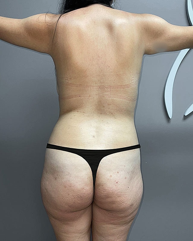 Brazilian Butt Lift Before & After