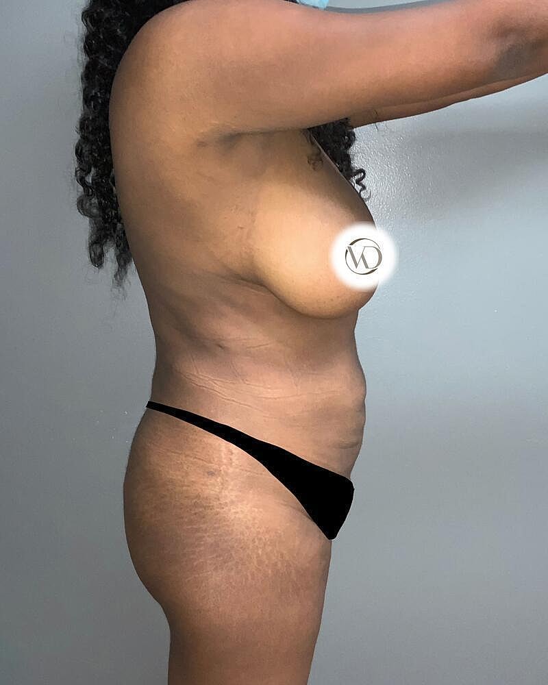 Brazilian Butt Lift Before & After