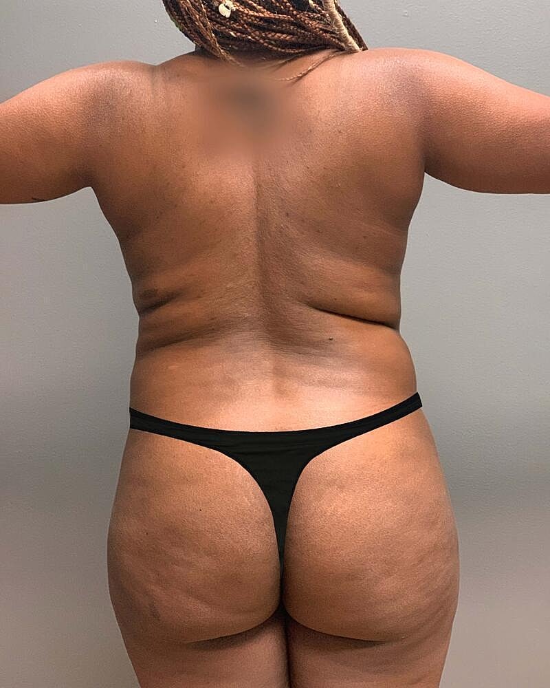 Brazilian Butt Lift Before & After