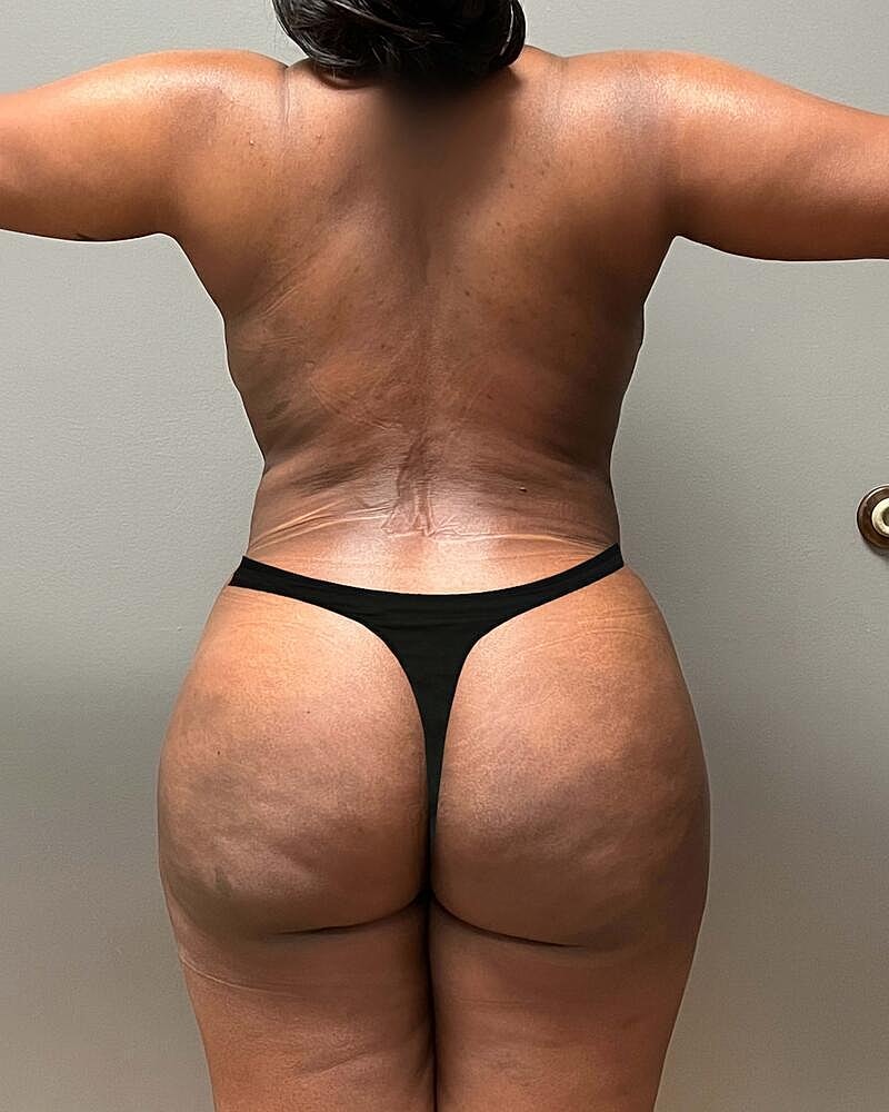 Brazilian Butt Lift Before & After