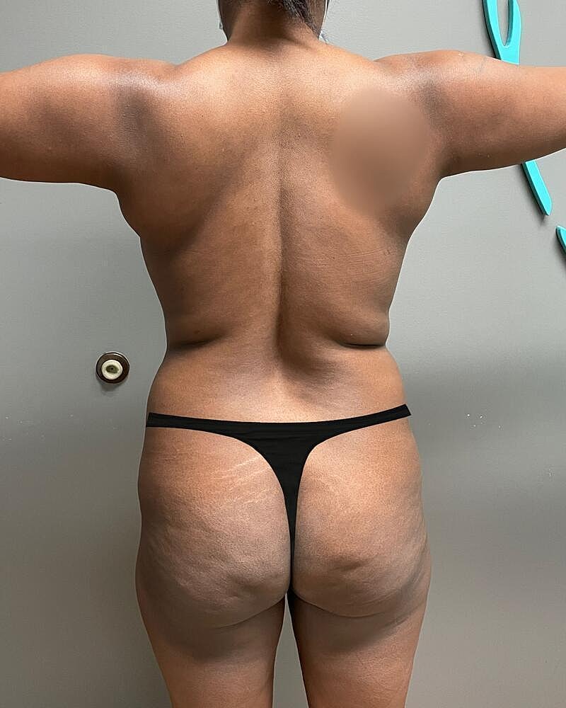 Brazilian Butt Lift Before & After