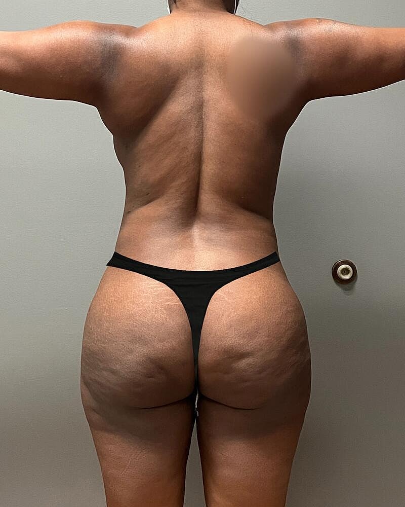 Brazilian Butt Lift Before & After