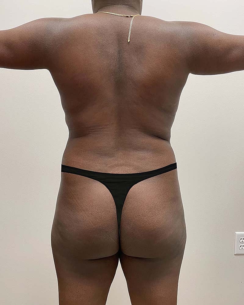 Brazilian Butt Lift Before & After