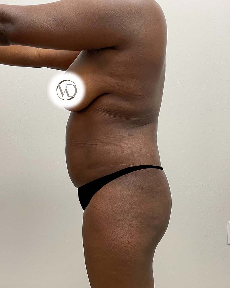 Brazilian Butt Lift Before & After