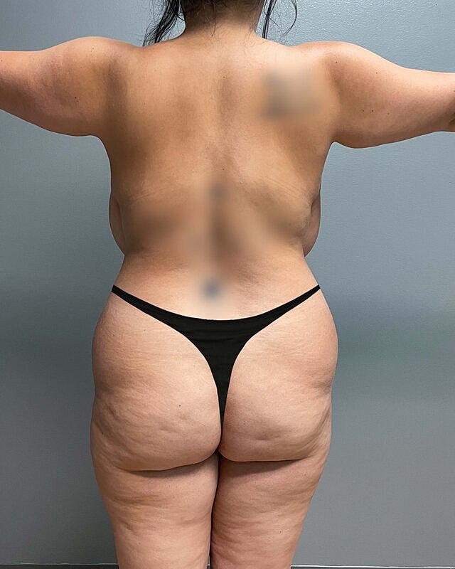 Brazilian Butt Lift Before & After