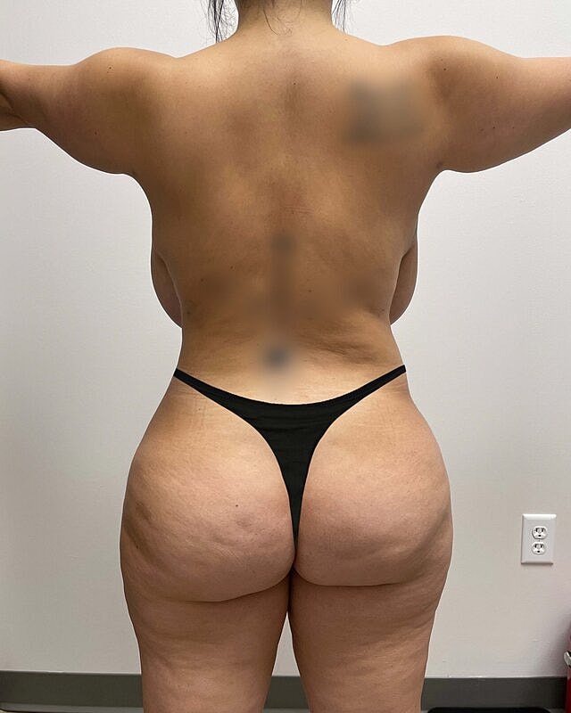 Brazilian Butt Lift Before & After