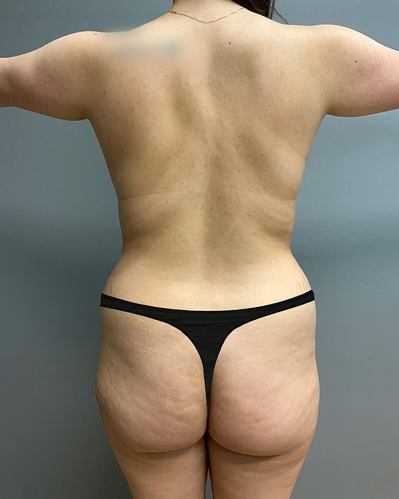 Brazilian Butt Lift Before & After