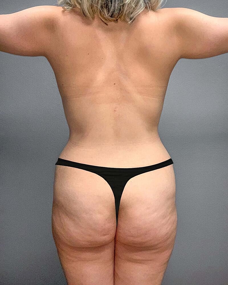 Brazilian Butt Lift Before & After