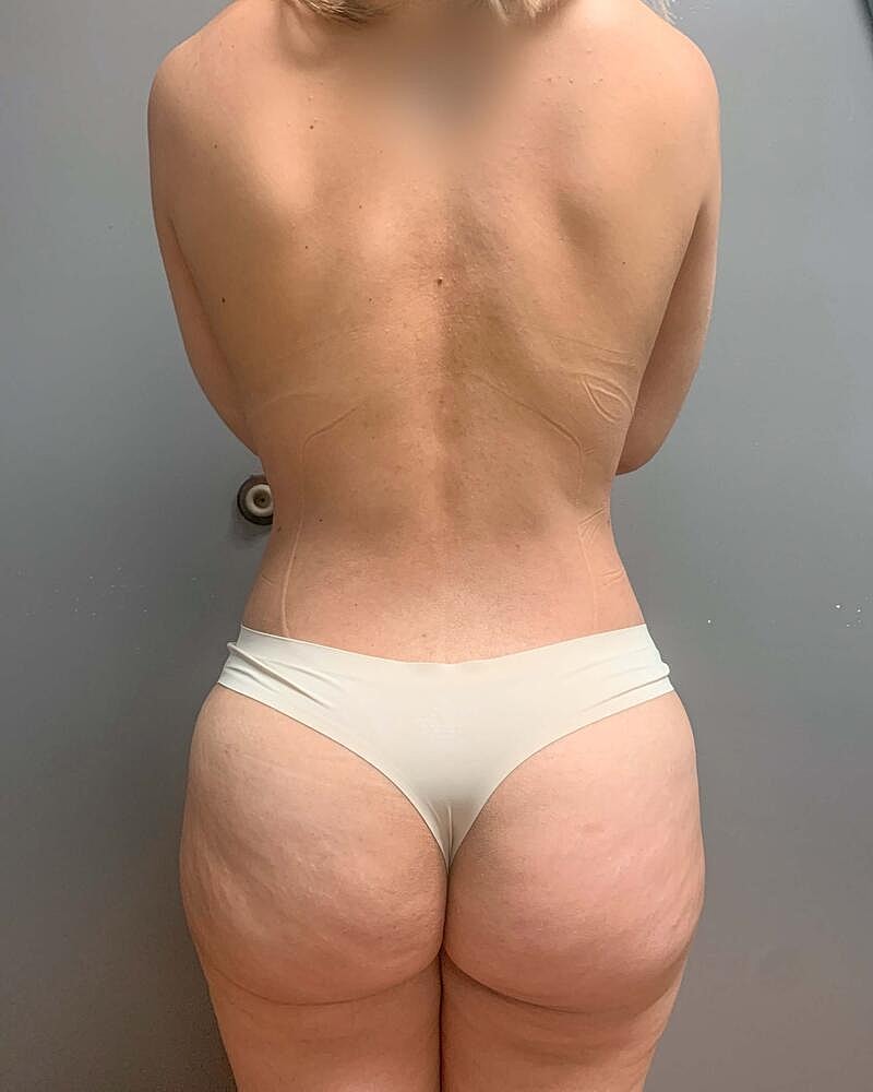 Brazilian Butt Lift Before & After