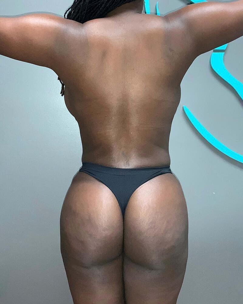 Brazilian Butt Lift Before & After