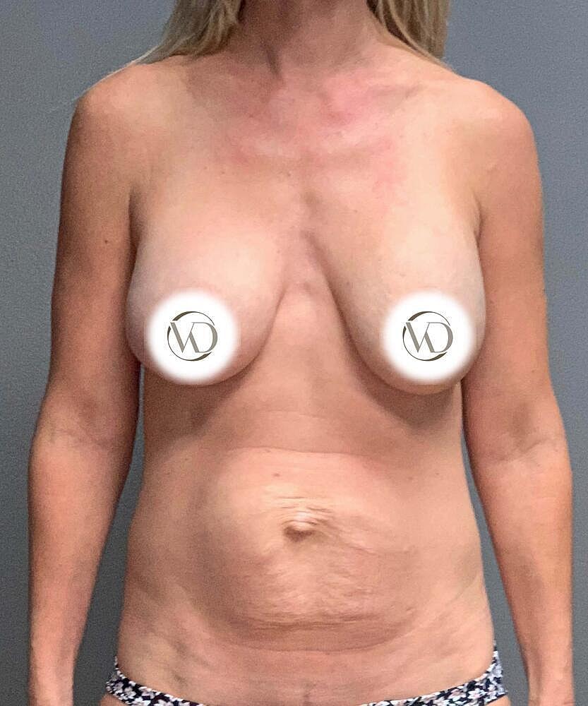 Breast Lift With Implant Exchange Before & After