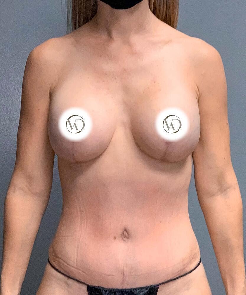 Breast Lift With Implant Exchange Before & After