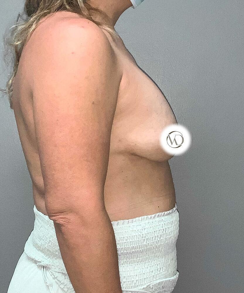 Breast Lift With Implant Exchange Before & After