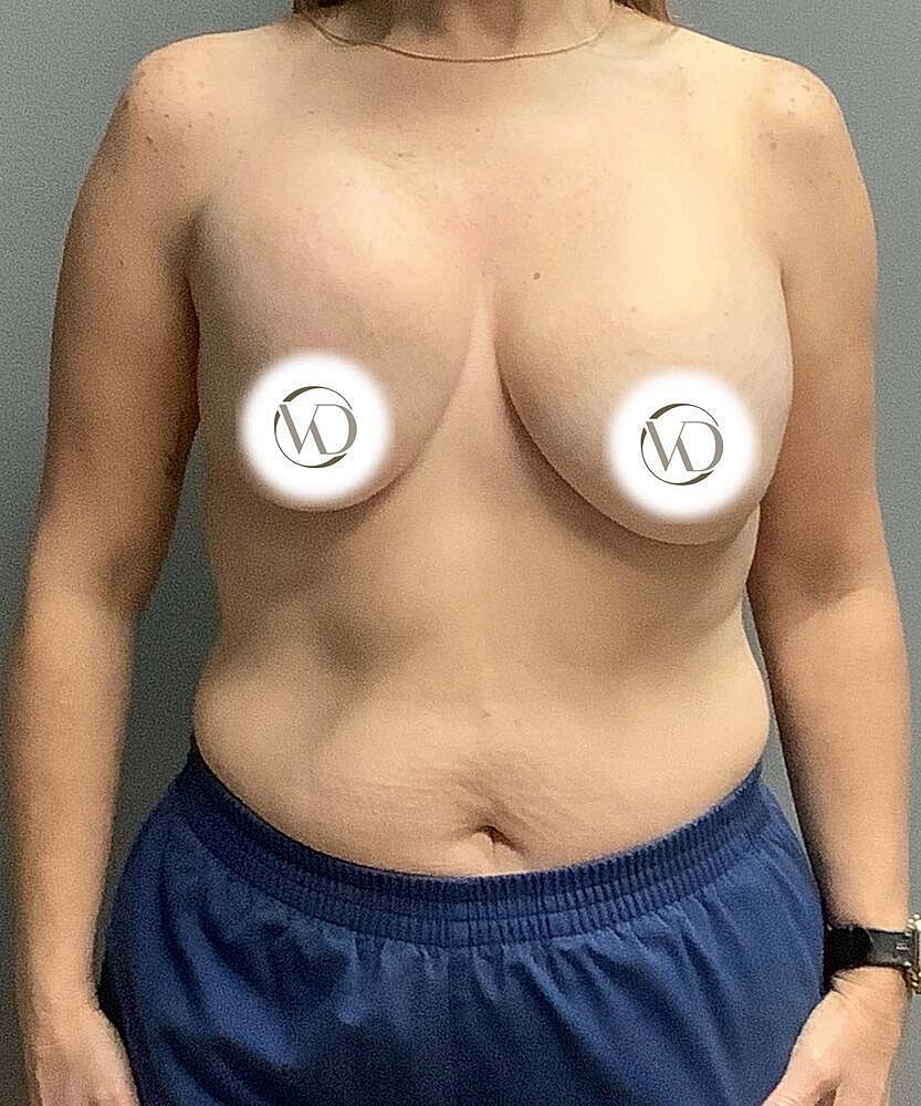 Breast Lift With Implant Exchange Before & After