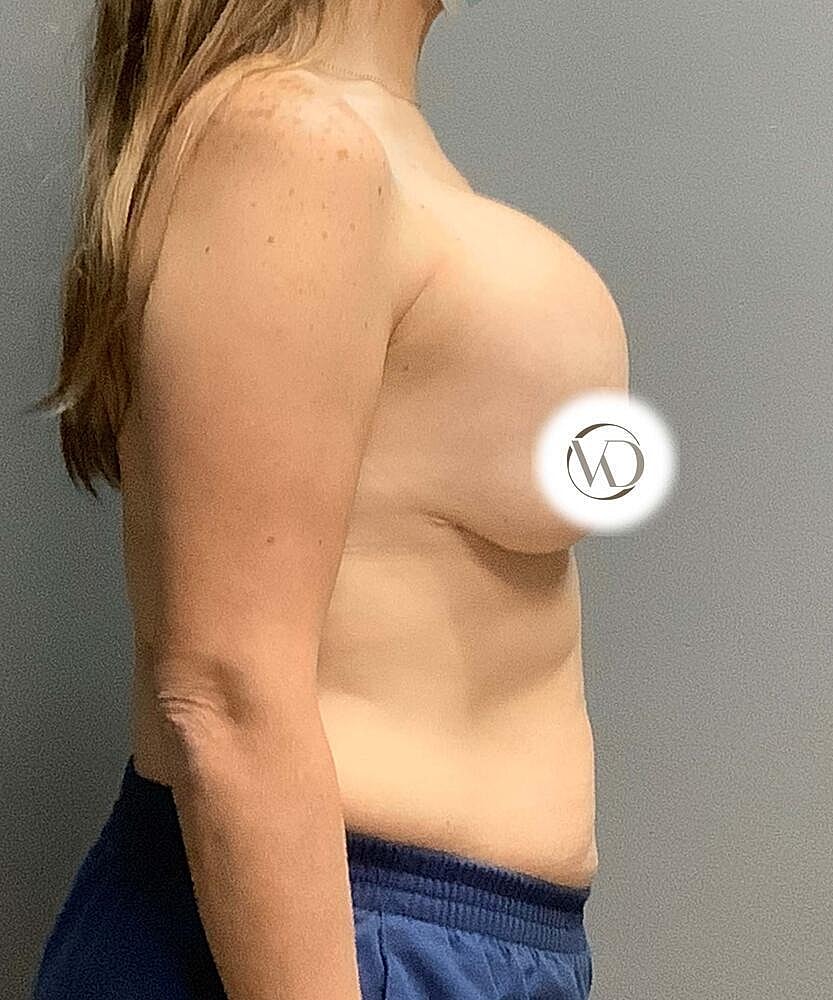 Breast Lift With Implant Exchange Before & After