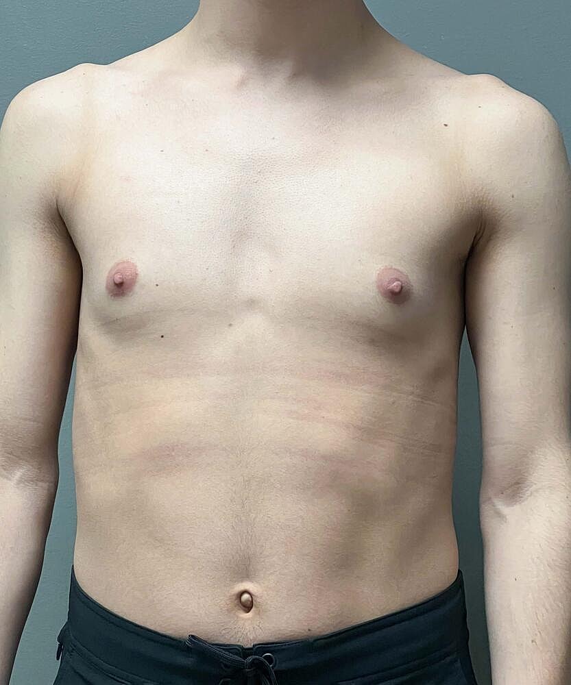 Gynecomastectomy Before & After