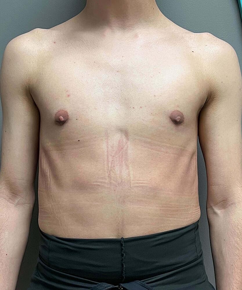 Gynecomastectomy Before & After