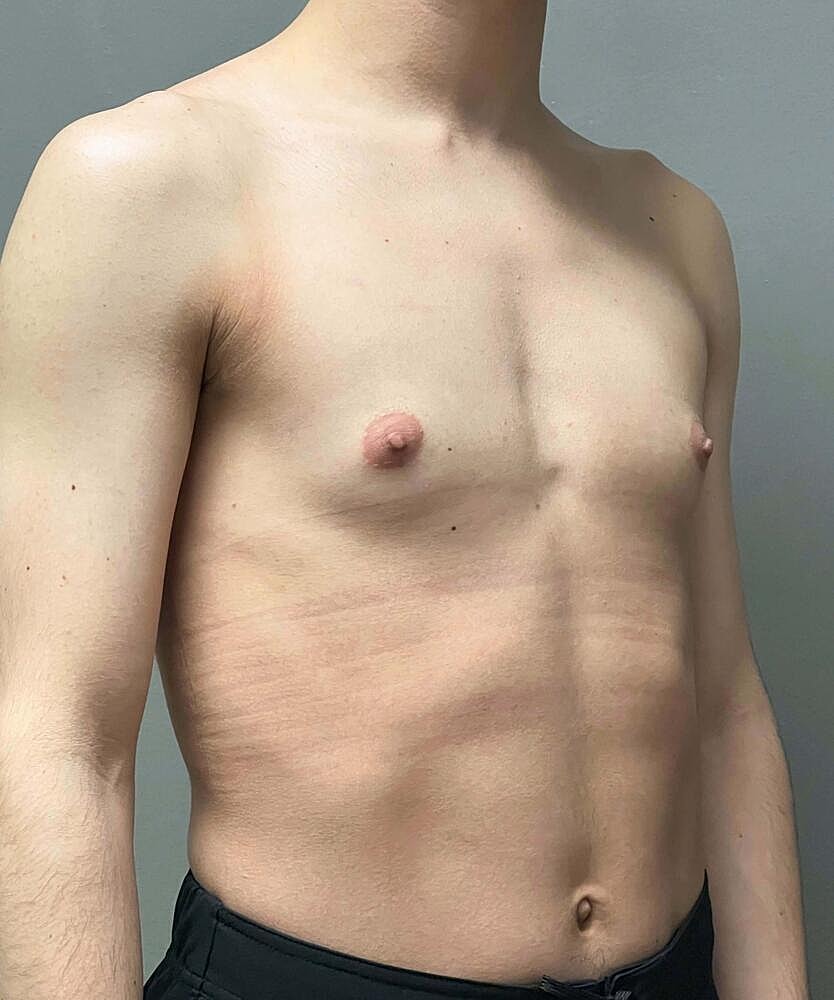 Gynecomastectomy Before & After