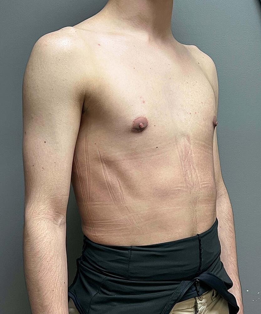 Gynecomastectomy Before & After