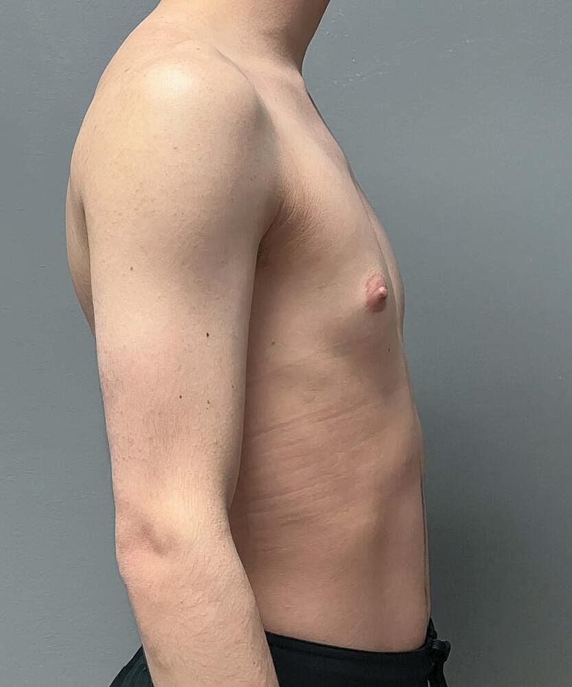 Gynecomastectomy Before & After