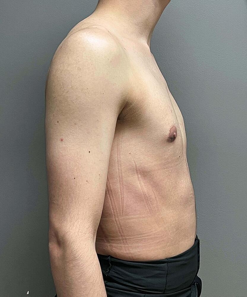 Gynecomastectomy Before & After