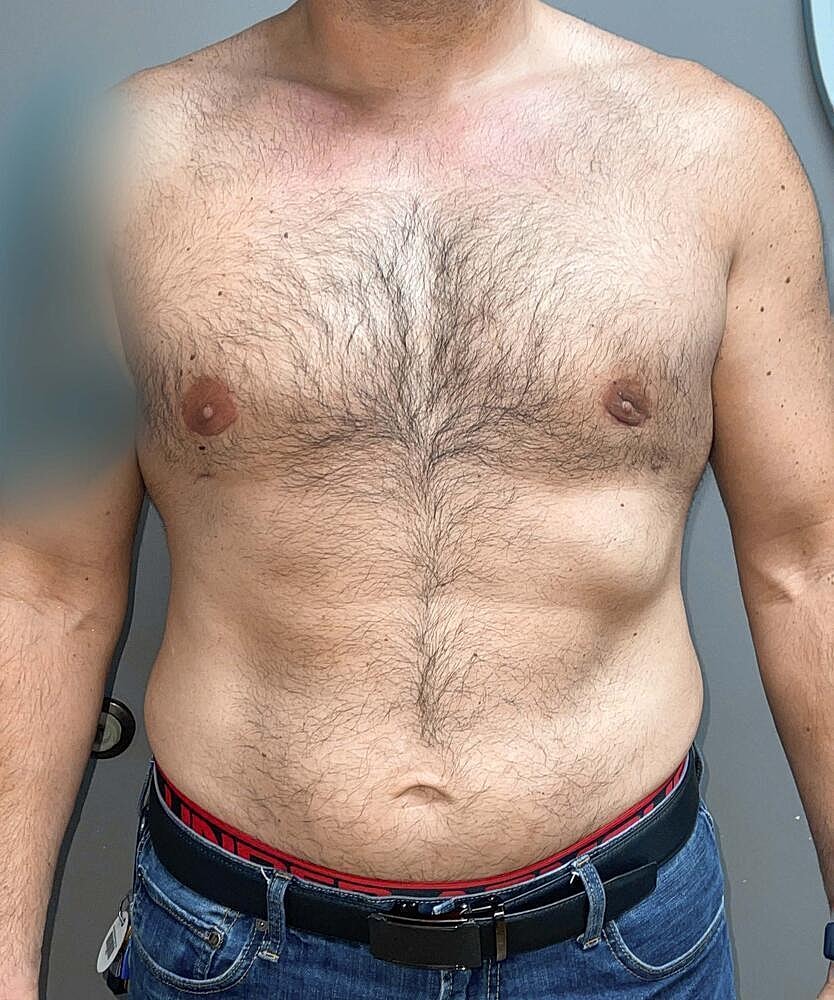 Gynecomastectomy Before & After