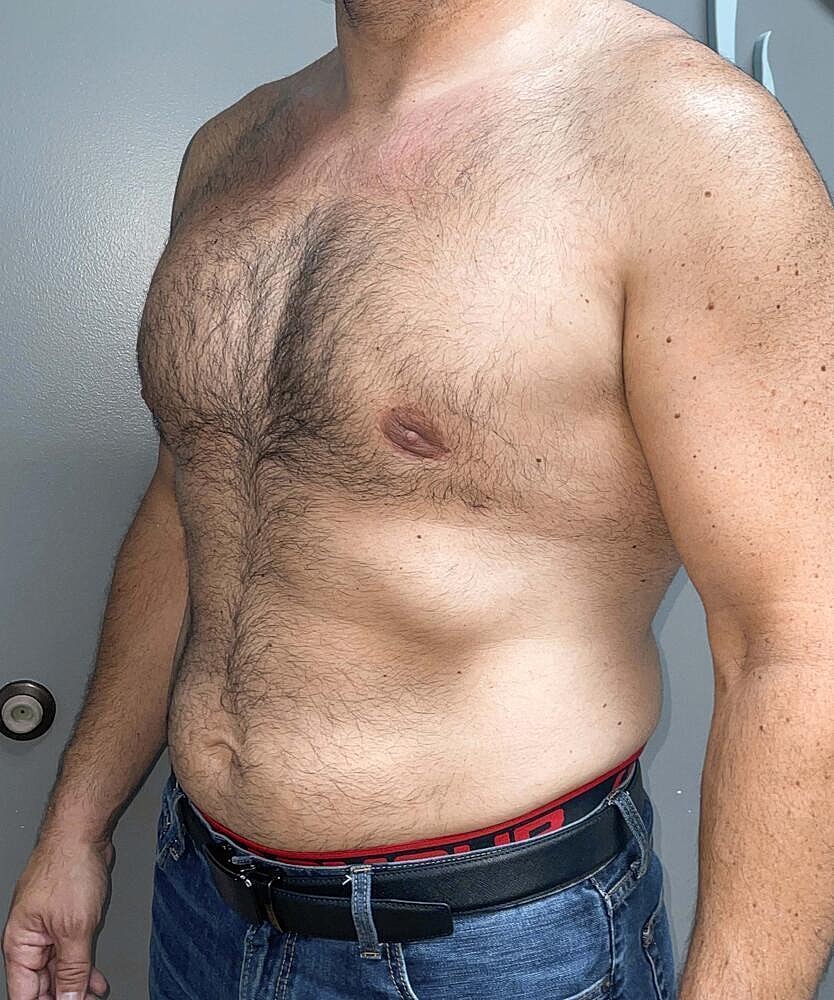 Gynecomastectomy Before & After