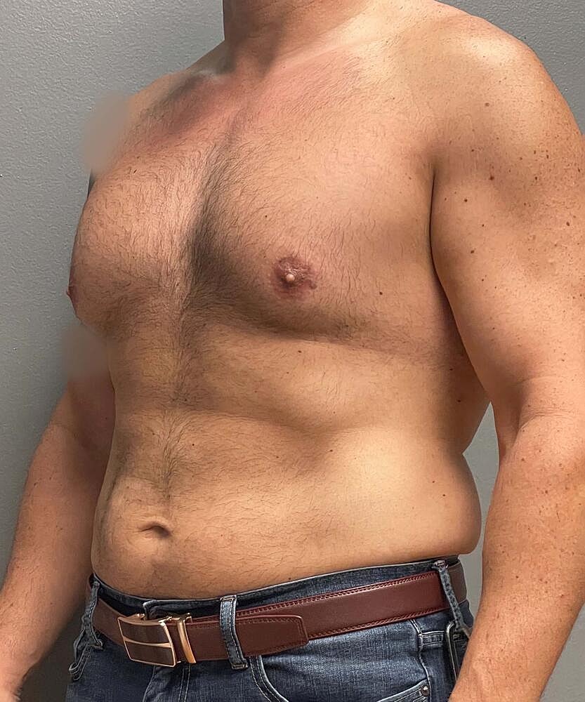 Gynecomastectomy Before & After