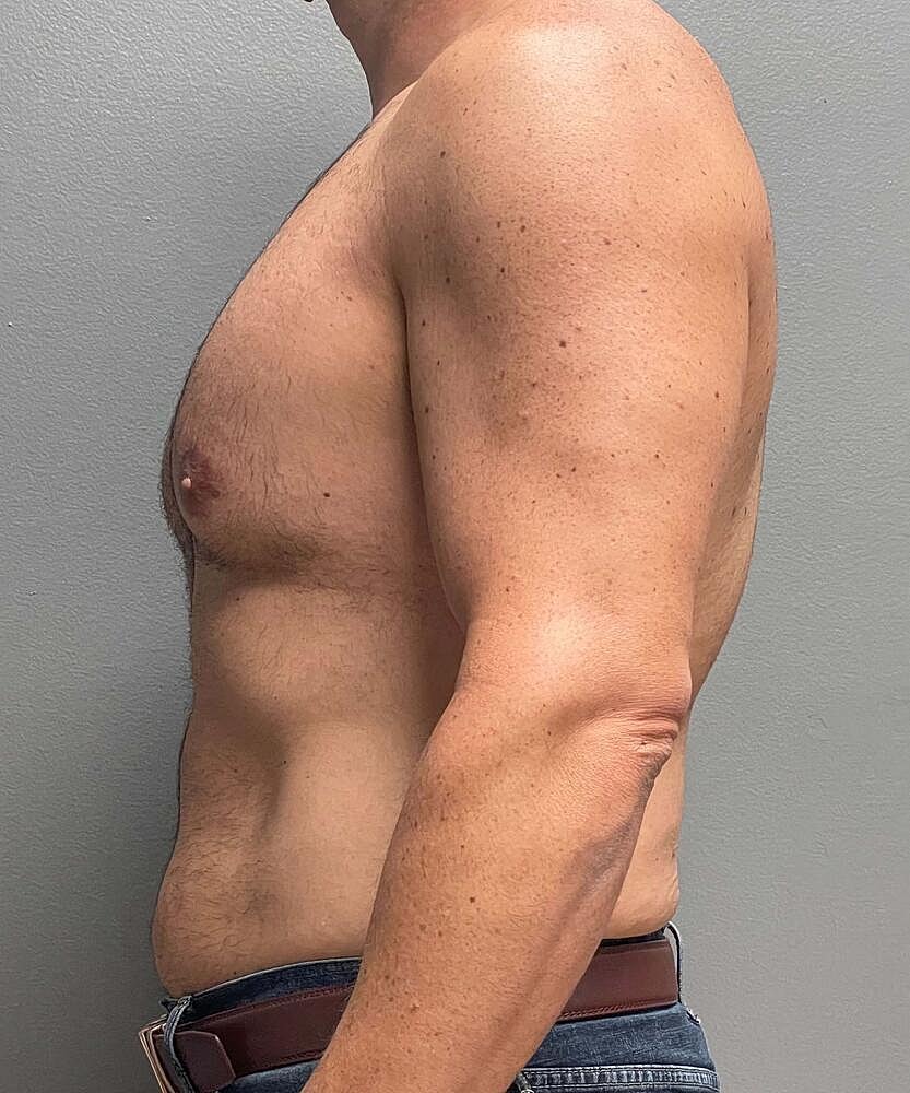 Gynecomastectomy Before & After
