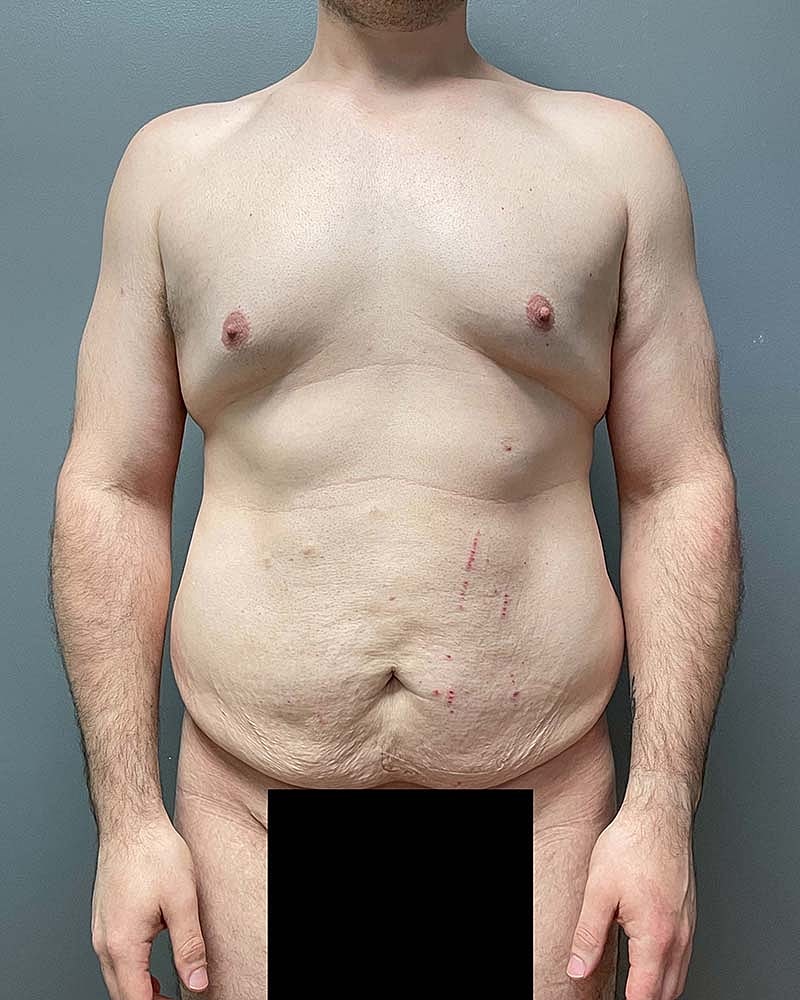 Gynecomastectomy Before & After