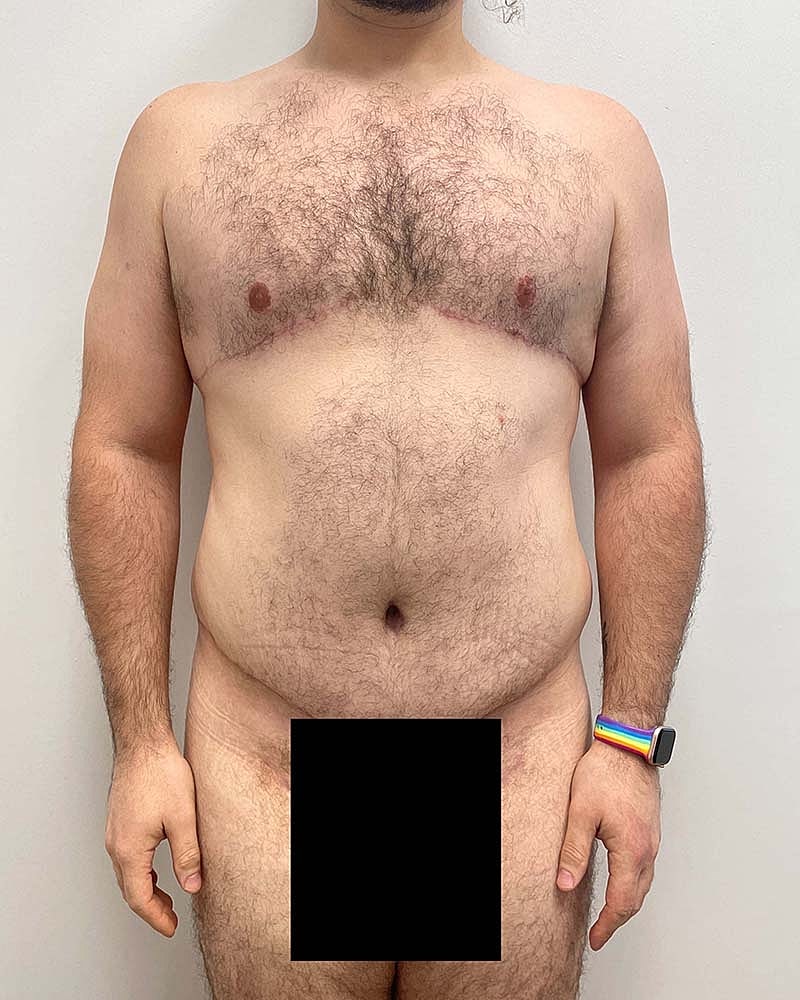 Gynecomastectomy Before & After
