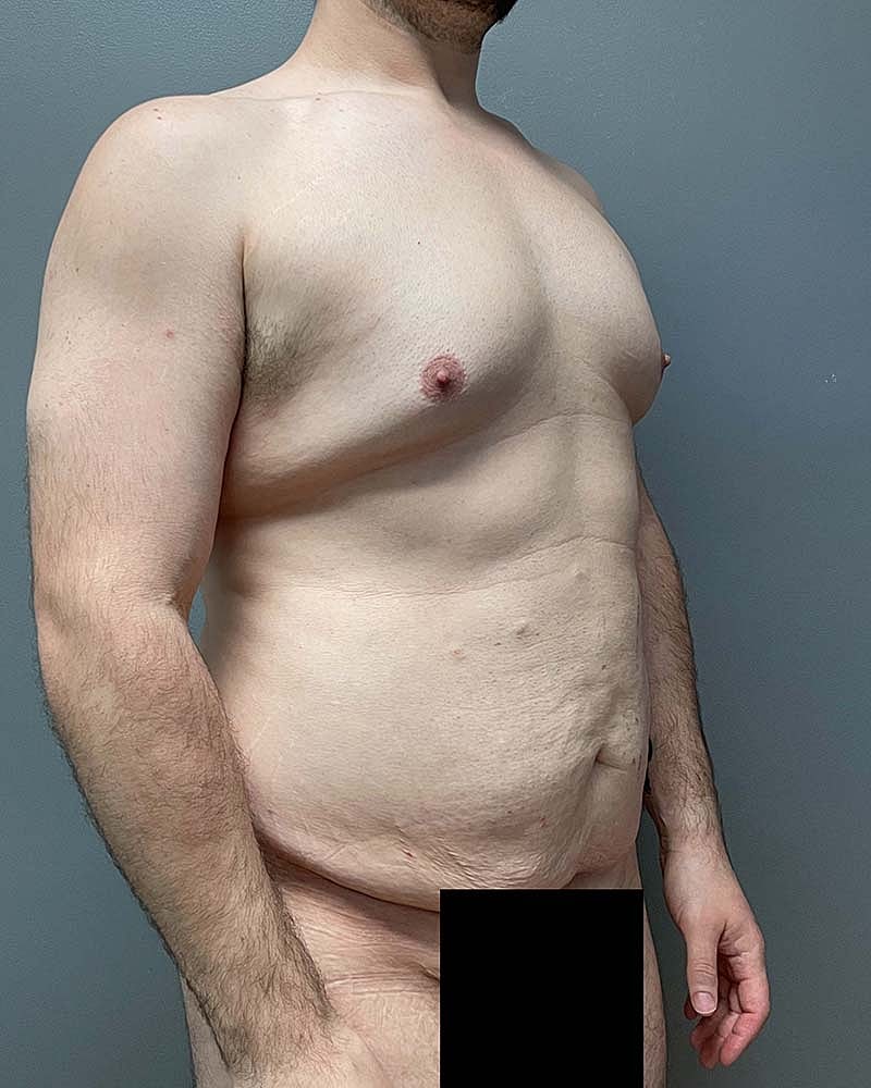Gynecomastectomy Before & After