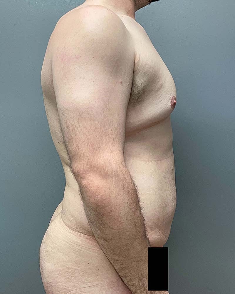 Gynecomastectomy Before & After