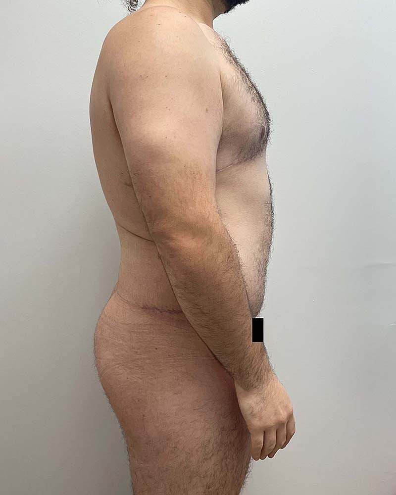 Gynecomastectomy Before & After
