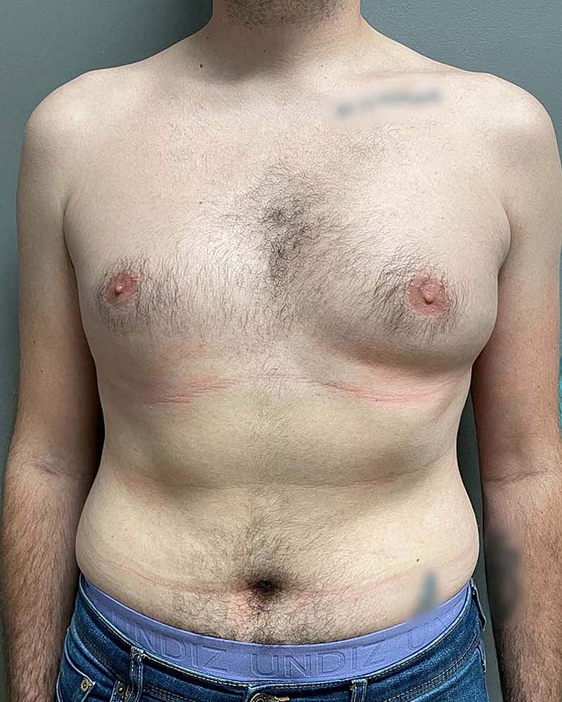 Gynecomastectomy Before & After