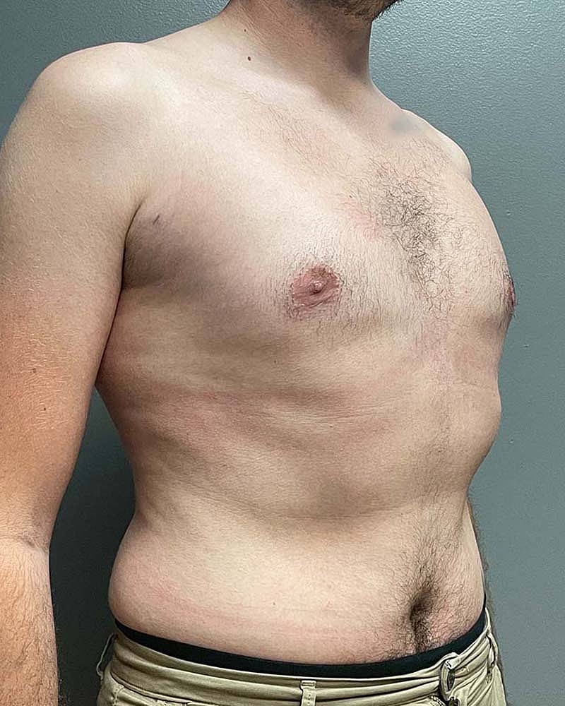 Gynecomastectomy Before & After