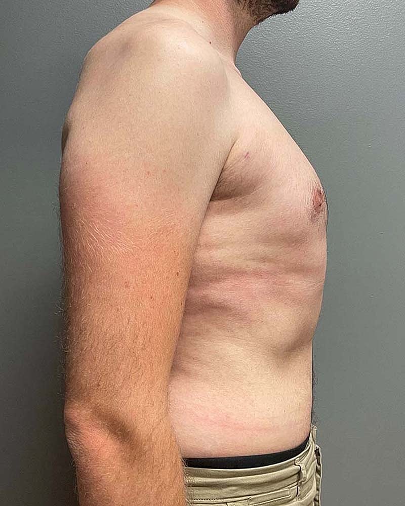 Gynecomastectomy Before & After