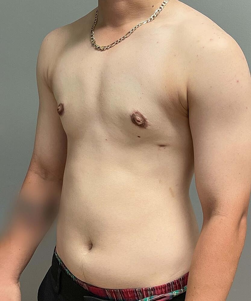 Gynecomastectomy Before & After