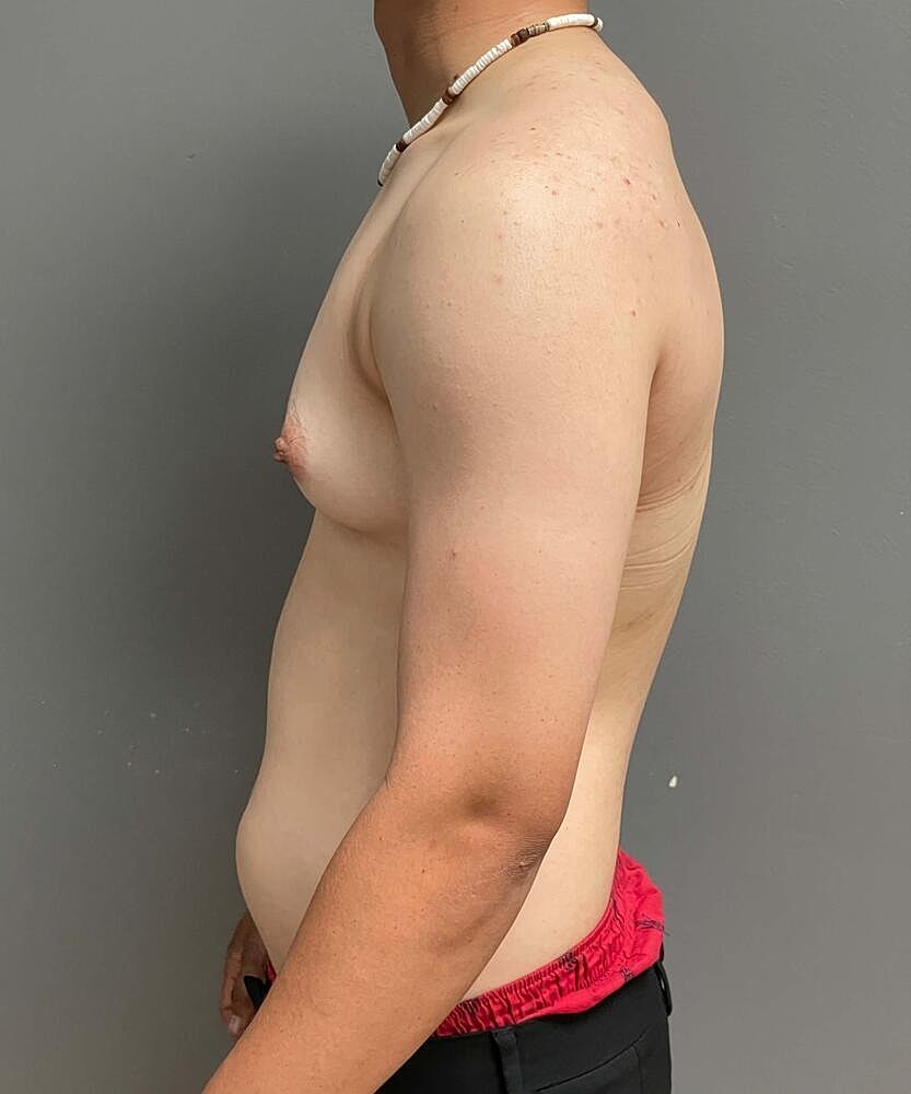 Gynecomastectomy Before & After