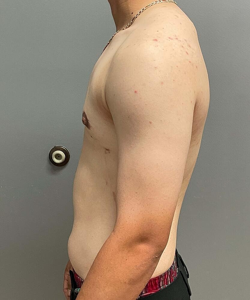 Gynecomastectomy Before & After