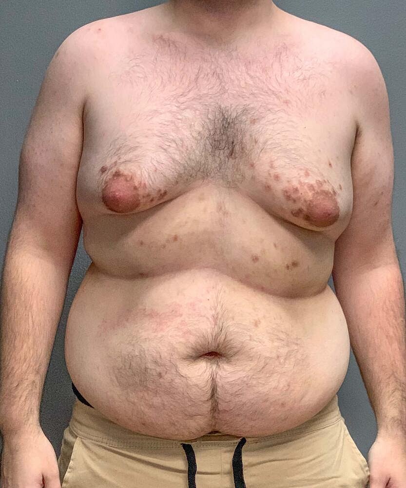Gynecomastectomy Before & After