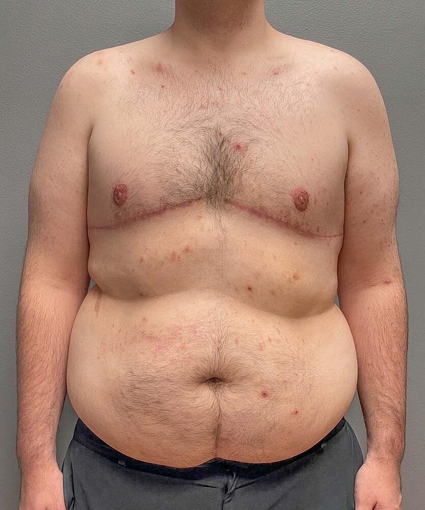 Gynecomastectomy Before & After