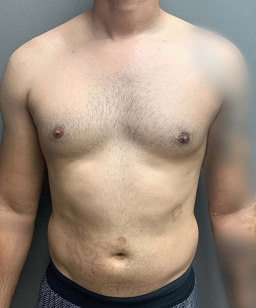 Gynecomastectomy Before & After