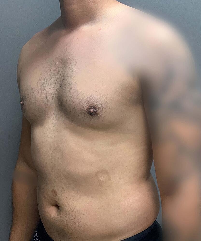 Gynecomastectomy Before & After