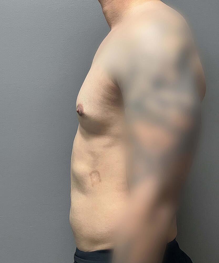 Gynecomastectomy Before & After